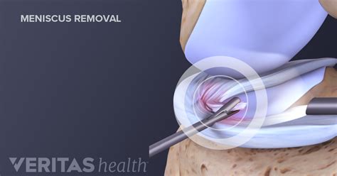 Meniscal Tear Treatment