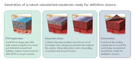 Top 9 Questions About Using Novosorb Btm In A Clinical Setting Polynovo