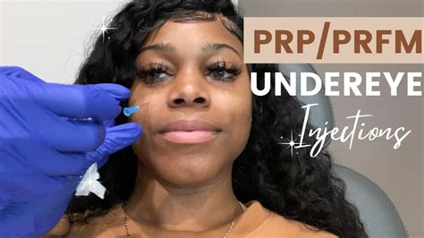 PRP PRFM Under Eye Injections DARK CIRCLES AND VOLUME LOSS UNDER YOUR