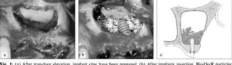 Figure 1 From Maxillary Sinus Augmentation Using Deproteinized Bovine