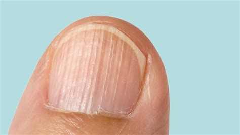 Rheumatoid Arthritis Nail Changes