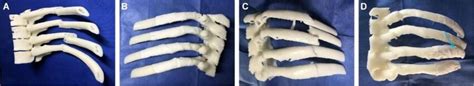 3D model of rib fracture after reduction of fractured end. (A ...