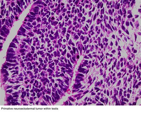 Pathology Outlines Teratoma With Somatic Type Malignancy