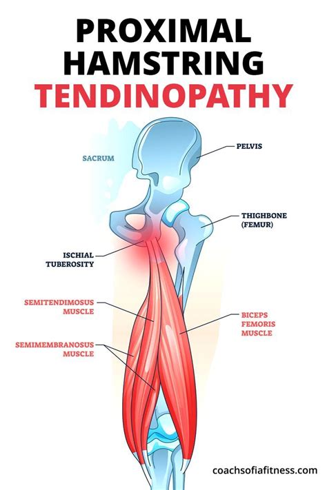 Running hamstring pain causes treatment and prevention plan – Artofit