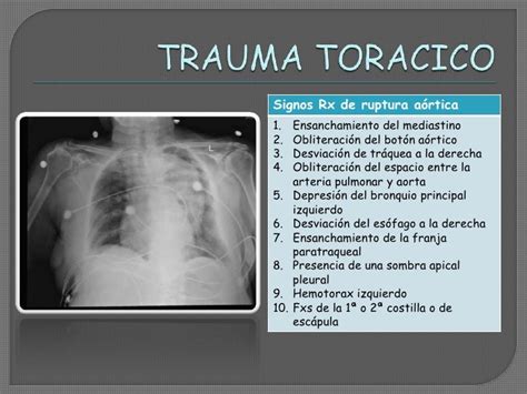 Trauma Toracico