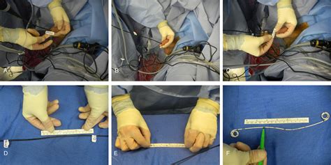 Fluoro-less Ureteral Stent Placement Following Uncomplicated