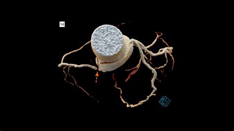 Spontaneous Localized Dissection Of The Right Coronary Sinus Of