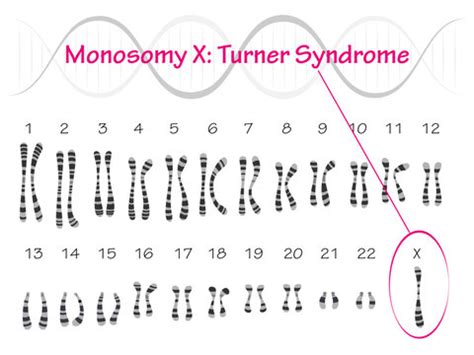 Turner Syndrome Karyotype