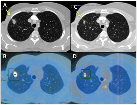 A Year Old Female Affected By Breast Cancer With Lung Metastasis