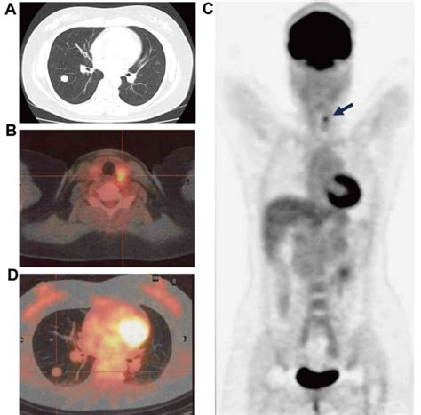 Benign Metastasizing Leiomyoma And 18FDGPET CT A Case Report And