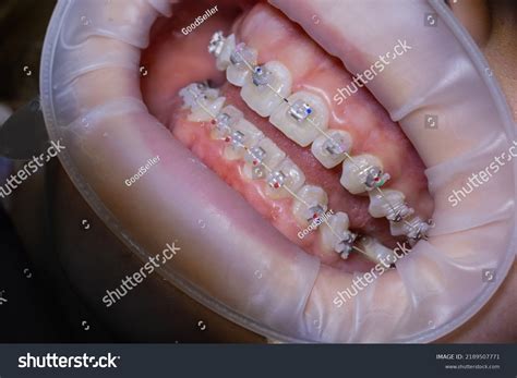 closeup mouth dental braces brackets stock photo  shutterstock