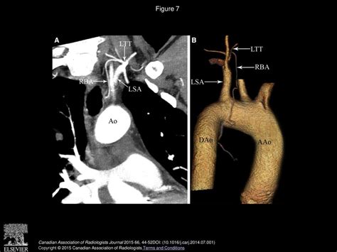 The Normal Anatomy And Variations Of The Bronchial Arteries Evaluation