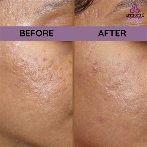 MNRF Treatment In Chennai RF Microneedling Doctor