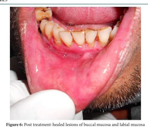 List 90 Pictures Pictures Of Oral Lichen Planus Sharp