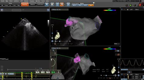 Clinical Results And Safety Of Intracardiac Echocardiography Guidance