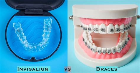 Braces Vs Invisalign For Overbite At Raymond Ocasio Blog