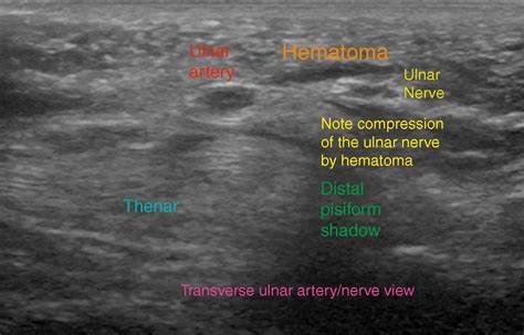 Ulnar Nerve Block At The Wrist Clinical Tree