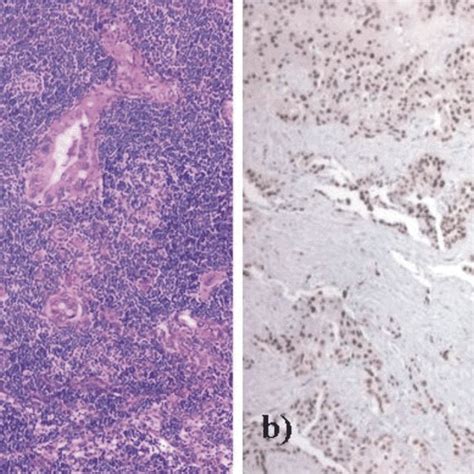 Metastasis Of A Pulmonary Adenocarcinoma A He Stain ×100 B Download Scientific Diagram