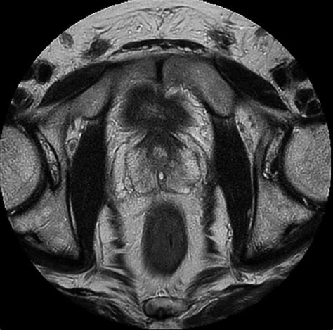 Prostate Imaging Philips Mr Body Map