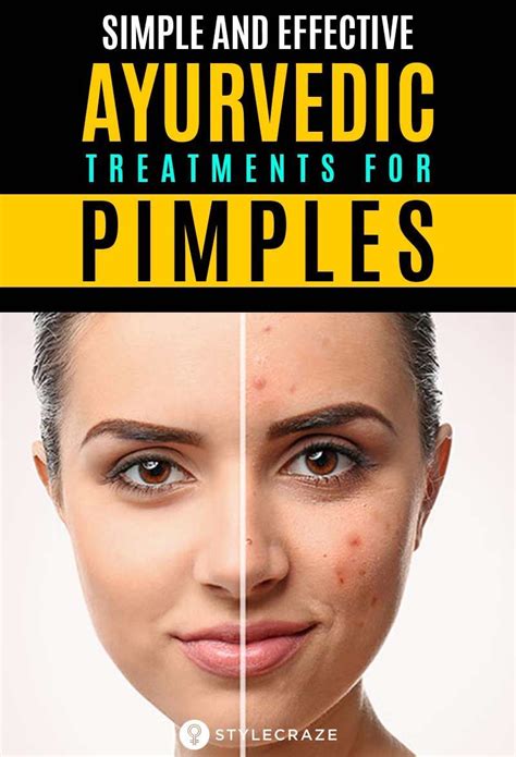 10 Best Ayurvedic Tips And Remedies For Acne Free Clear Skin Pimple Treatment Pimples