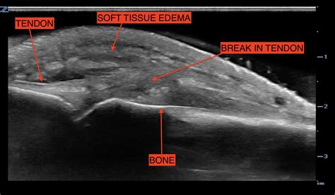 fight bite  tendon laceration jetem