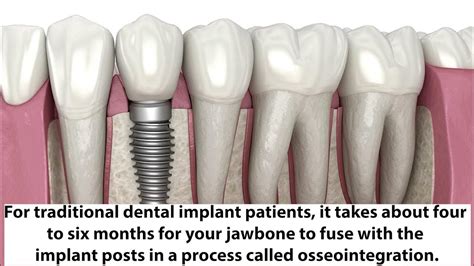 Dental Implant Timeline Youtube