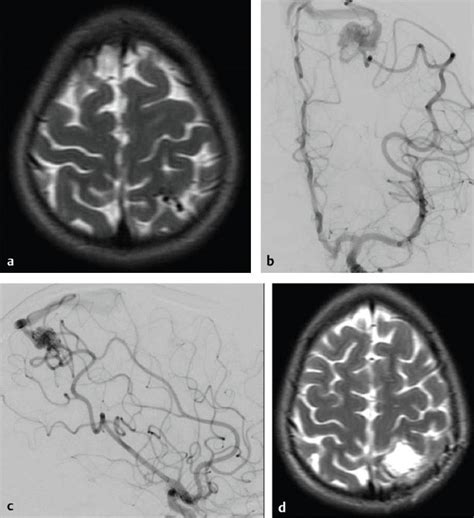 Management Of Unruptured Brain Arteriovenous Malformations Neupsy Key