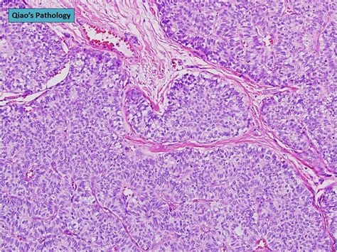 Qiaos Pathology Solid Papillary Carcinoma Of The Breast A Photo On Flickriver