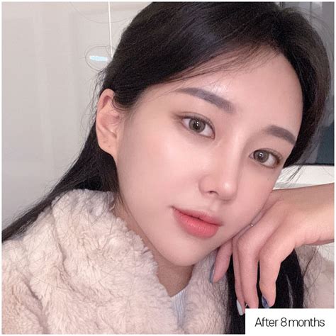 Bulbous Nose Correction | DA Plastic Surgery in Korea, Gangnam