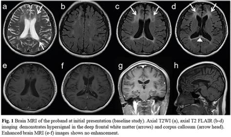 Adultonset Leukoencephalopathy With Axonal Spheroids And Pigmented