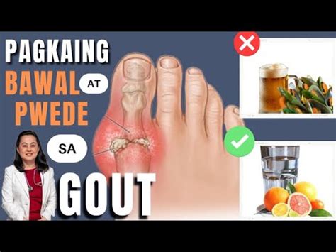 May Gout Pwede At Bawal Kainin By Doc Liza Ramoso Ong Youtube