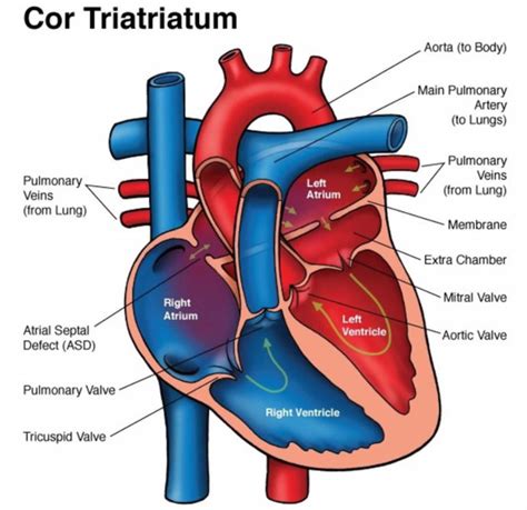 Cor Triatriatum Causes Symptoms Diagnosis Treatment And Prognosis