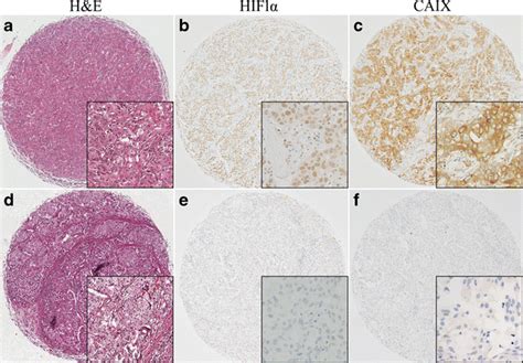 Histologic And Immunohistochemical Features In Representative Cases Of