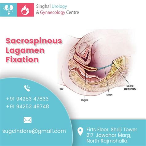 Sacrospinous Lagamen Fixation Vaginal Absorbable Suture Post Surgery