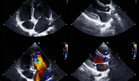 Transthoracic Echocardiography Echo North West Hospital Cardiology