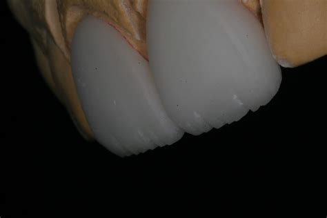 Anterior Veneer Materials - Restorative Nation