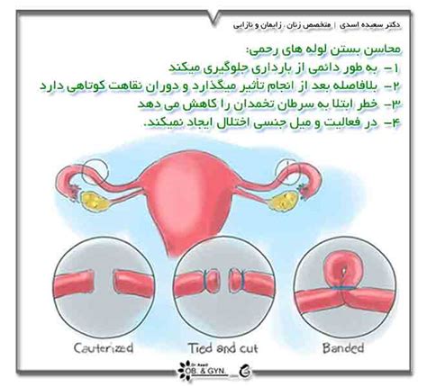 بستن لوله رحم یا توبکتومی در زنان چقدر موثر است؟ عوارض