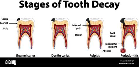 Infographic Of Human In The Stages Of Tooth Decay Illustration Stock