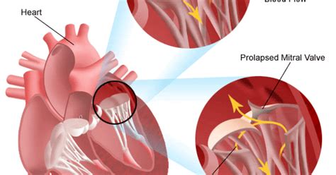 Milan S Surgery Updates Mitral Valve Prolapse