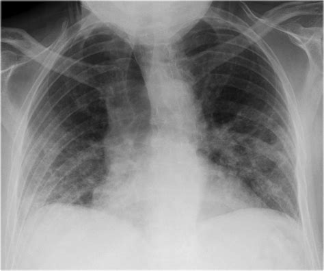 Structured Reporting In Portable Chest Radiographs An Essential Tool