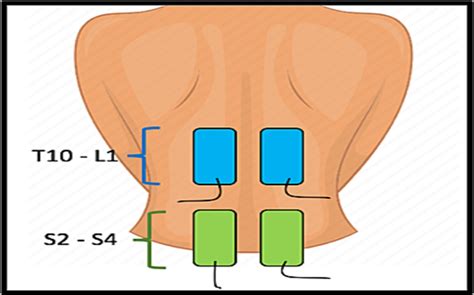 Analgesia Using Transcutaneous Electric Nerve Stimulation In