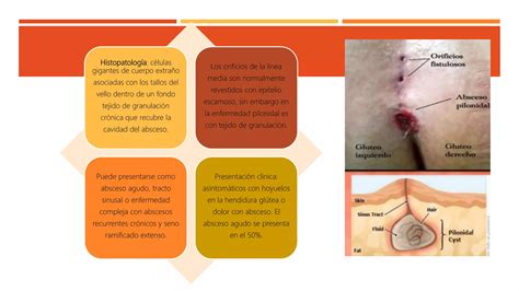 Abscesos Fistulas Perianales Y Quiste Pilonidal PPT