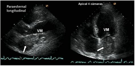 Valoración anatómica de la estenosis mitral