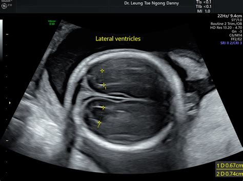 Lateral Ventricles Fetal Brain Ultrasound