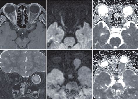 A Right Sided Optic Nerve Sheath Meningioma Shows A Tram Track Sign On