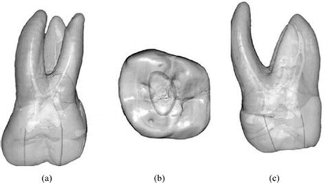 Maxillary 2nd Molar Root Canal Anatomy