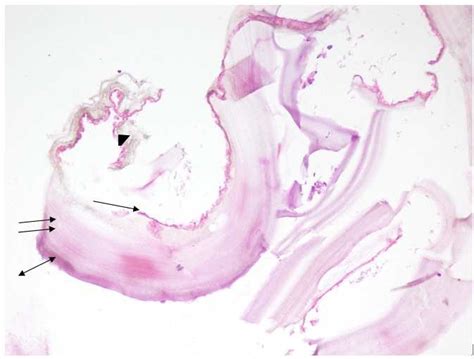 Histopathology Confirmed The Diagnosis Of Hydatid Cyst Showing The Download Scientific Diagram