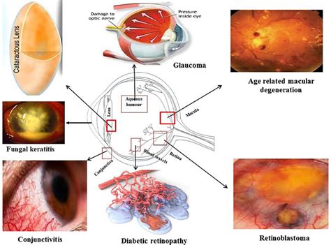 Various Ocular Diseases Affecting The Two Segments Of The Eye 1