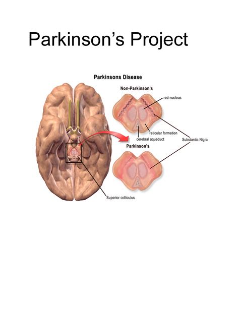 Parkinsons Project Notes About Parkinsons Parkinsons Project