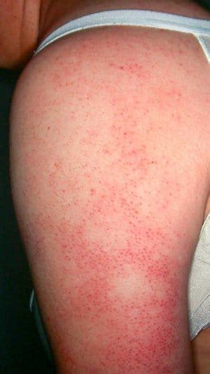 Understanding Bumpy "Chicken" Skin — Keratosis Pilaris - Zel Skin ...